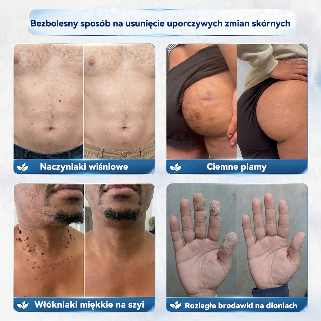 𝐏𝐢𝐜𝐝𝐨®🍐 7-𝐃𝐧𝐢𝐨𝐰𝐲 𝐊𝐫𝐞𝐦 𝐝𝐨 𝐔𝐬𝐮𝐰𝐚𝐧𝐢𝐚 𝐁𝐫𝐨𝐝𝐚𝐰𝐞𝐤 𝐢 𝐍𝐢𝐞𝐝𝐨𝐬𝐤𝐨𝐧𝐚𝐥𝐨ś𝐜𝐢 𝐒𝐤ó𝐫𝐲🩵 (𝑭𝒐𝒓𝒎𝒖ł𝒂 𝑩𝒆𝒛 𝑩ó𝒍𝒖 𝒊 𝑩𝒆𝒛 𝑩𝒍𝒊𝒛𝒏) 💪